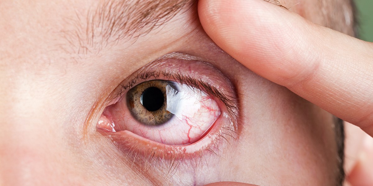 水泳後の赤目を防ぐためのヒント（およびその治療方法）