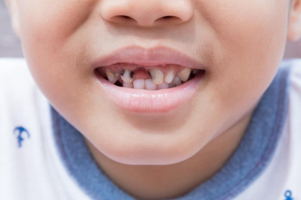 هذه الأشياء الستة يمكن أن تسبب أسنان الأطفال باللون الأسود ، كيف نمنعها؟