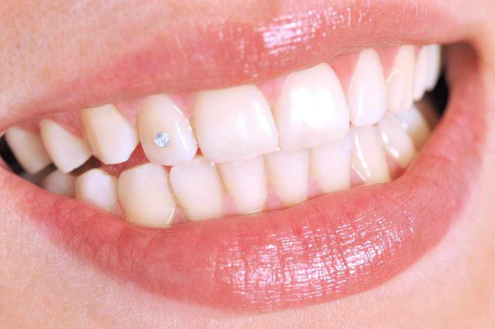 Procedure e rischi per l'installazione del diamante dentale