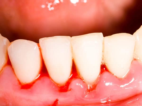 5 вида храни за лечение на кървене на венците