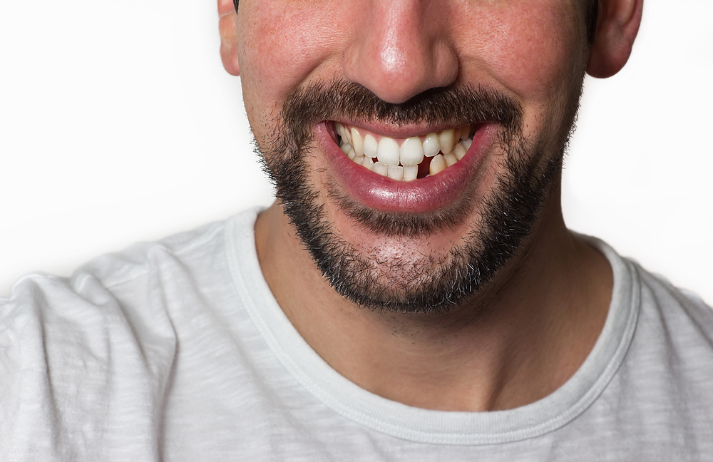 Se lo lasci continuare, lo stress pesante può rendere i tuoi denti sdentati!