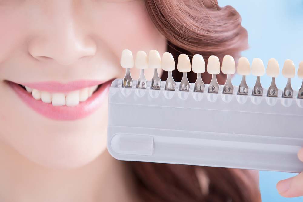 إلى متى يمكن أن تستمر آثار تبييض الأسنان عند الطبيب؟