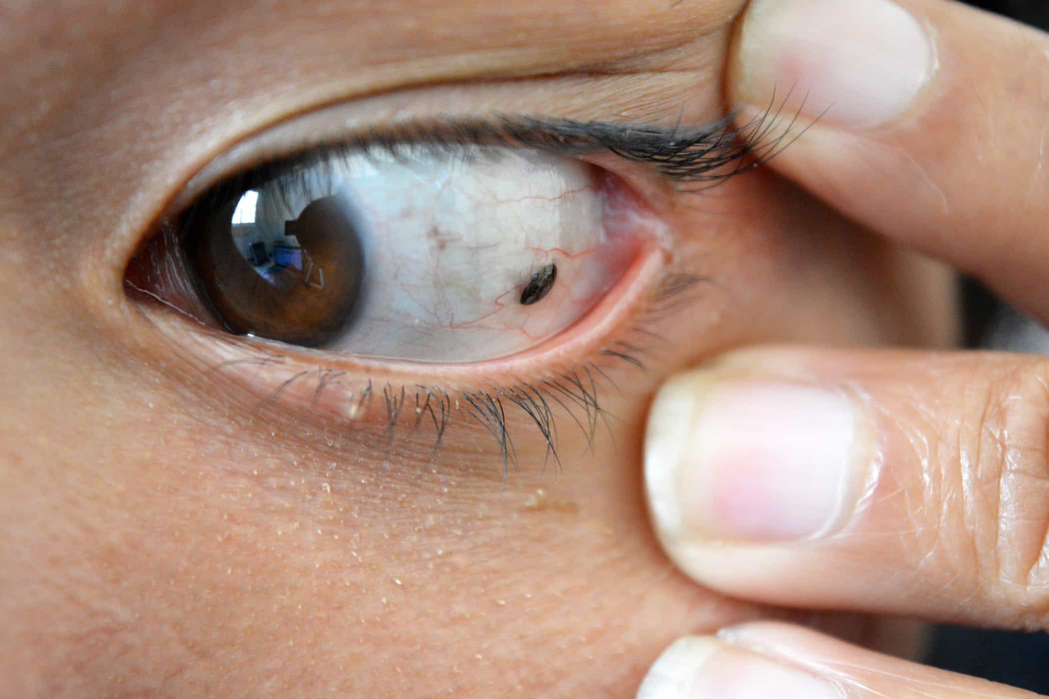 لا يهاجم الجلد فقط ، بل يمكن أن يظهر سرطان الجلد أيضًا في العين