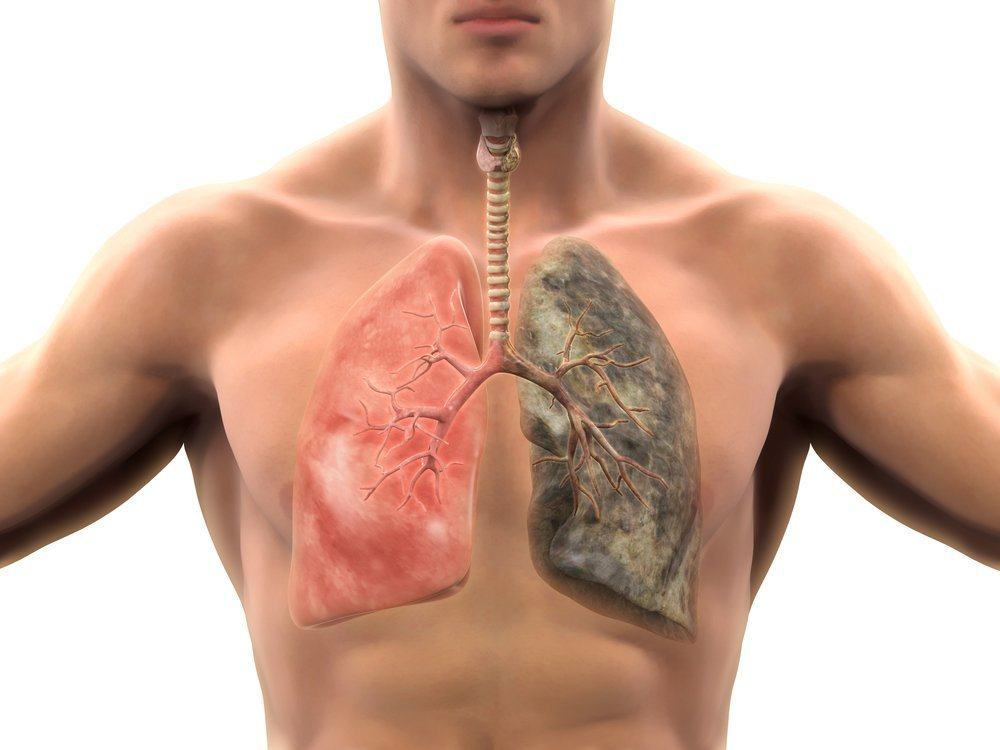 Различни причини и рискови фактори за рак на белия дроб