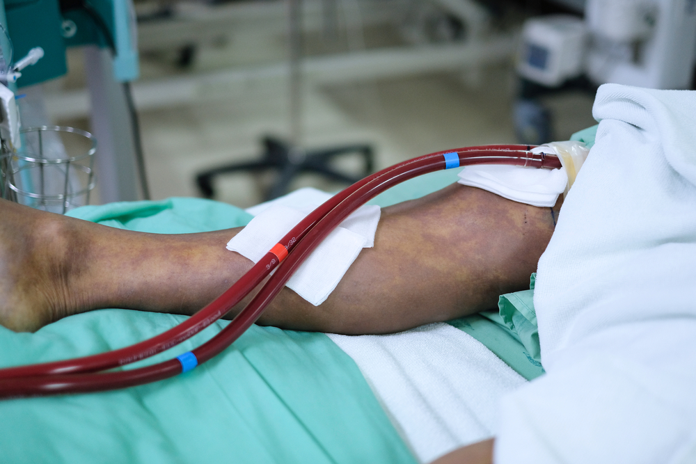 Mengakui Iskemia Limbah Kritikal (CLI), Komplikasi Penyakit Arteri Periferal