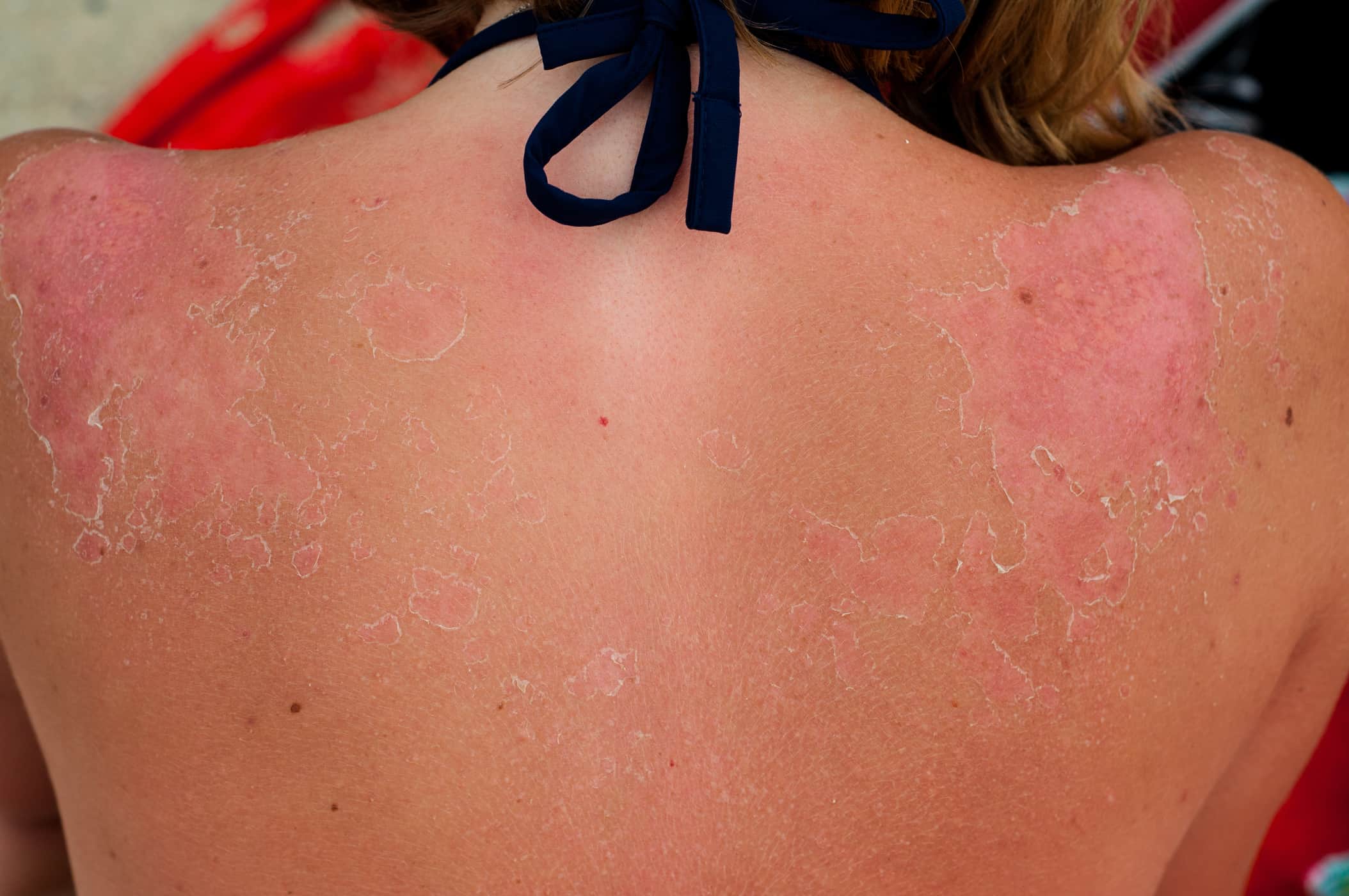 ما هي مدة شفاء الجلد المصاب بحروق الشمس؟