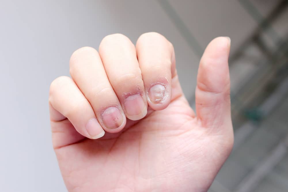 Може ли да се излекува псориазис на ноктите?
