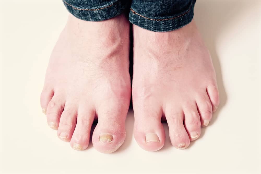 3 -те най -чести причини за дебели нокти на краката, плюс съвети за преодоляването им
