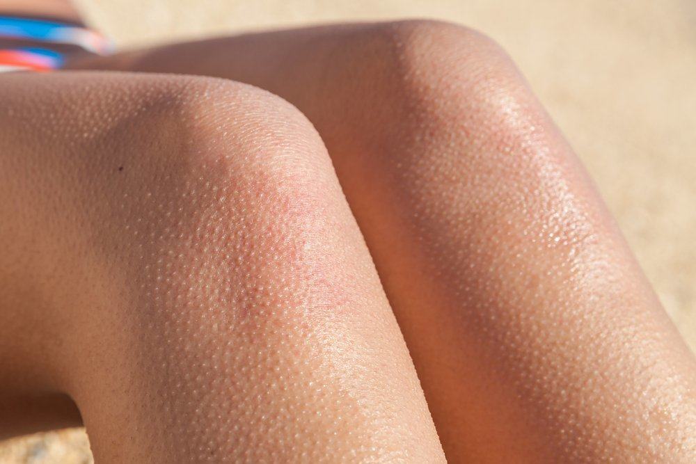 Ini adalah penyebab kulit kita boleh meresap