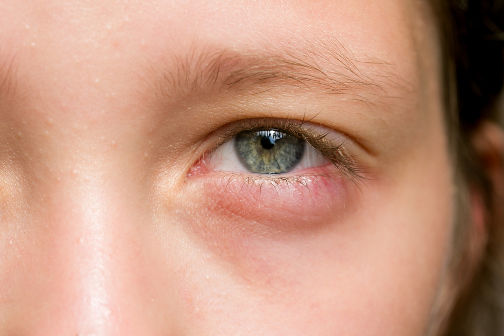 注意してください、甲状腺腫はまた目が腫れる原因となる可能性があります