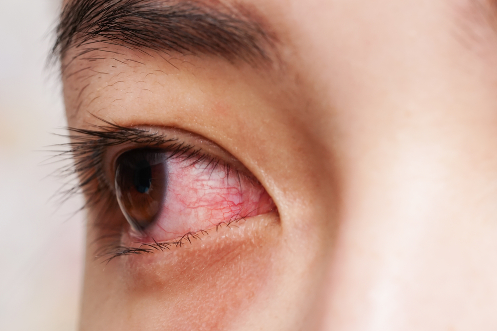 上強膜炎、特定の状態による眼球組織の軽度の炎症