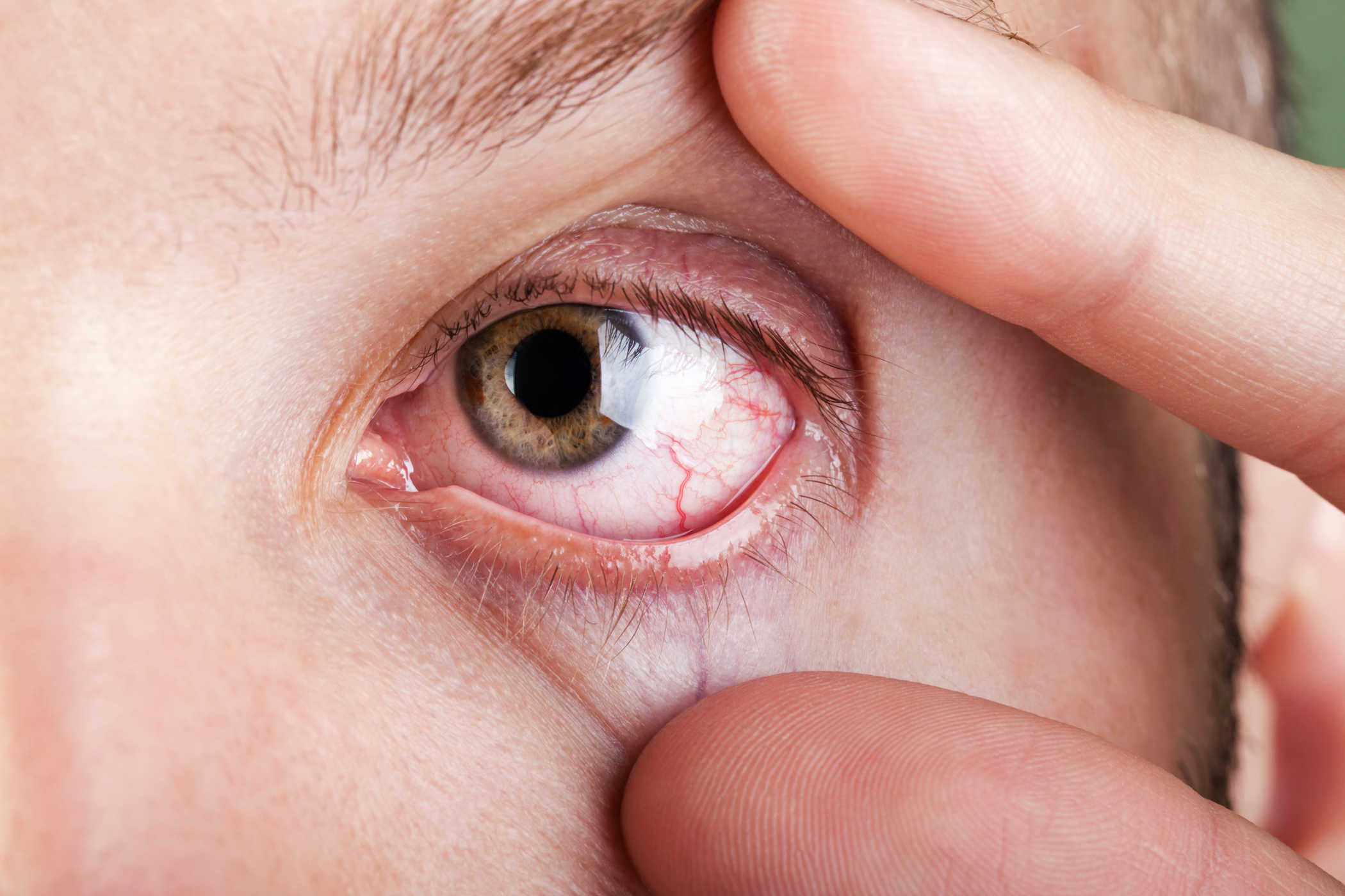 3 най -добри хранителни вещества за лечение на сухи очи