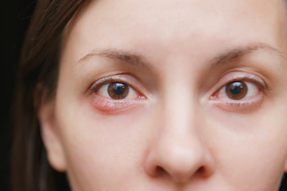麦粒腫が視線を介して伝染するというのは本当ですか？ここで事実を確認してください！