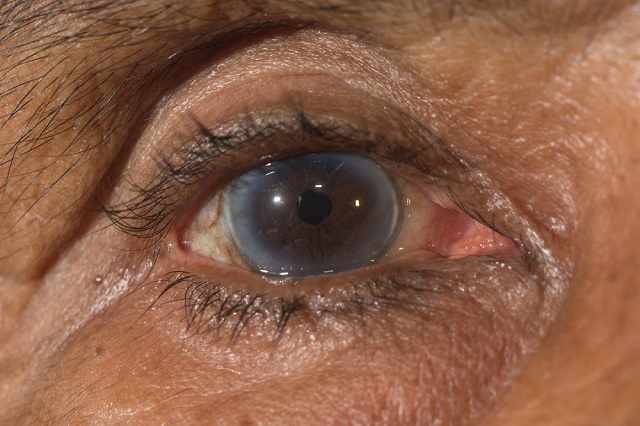 Иридотомия, Процедура за профилактика на затворена ъглова глаукома