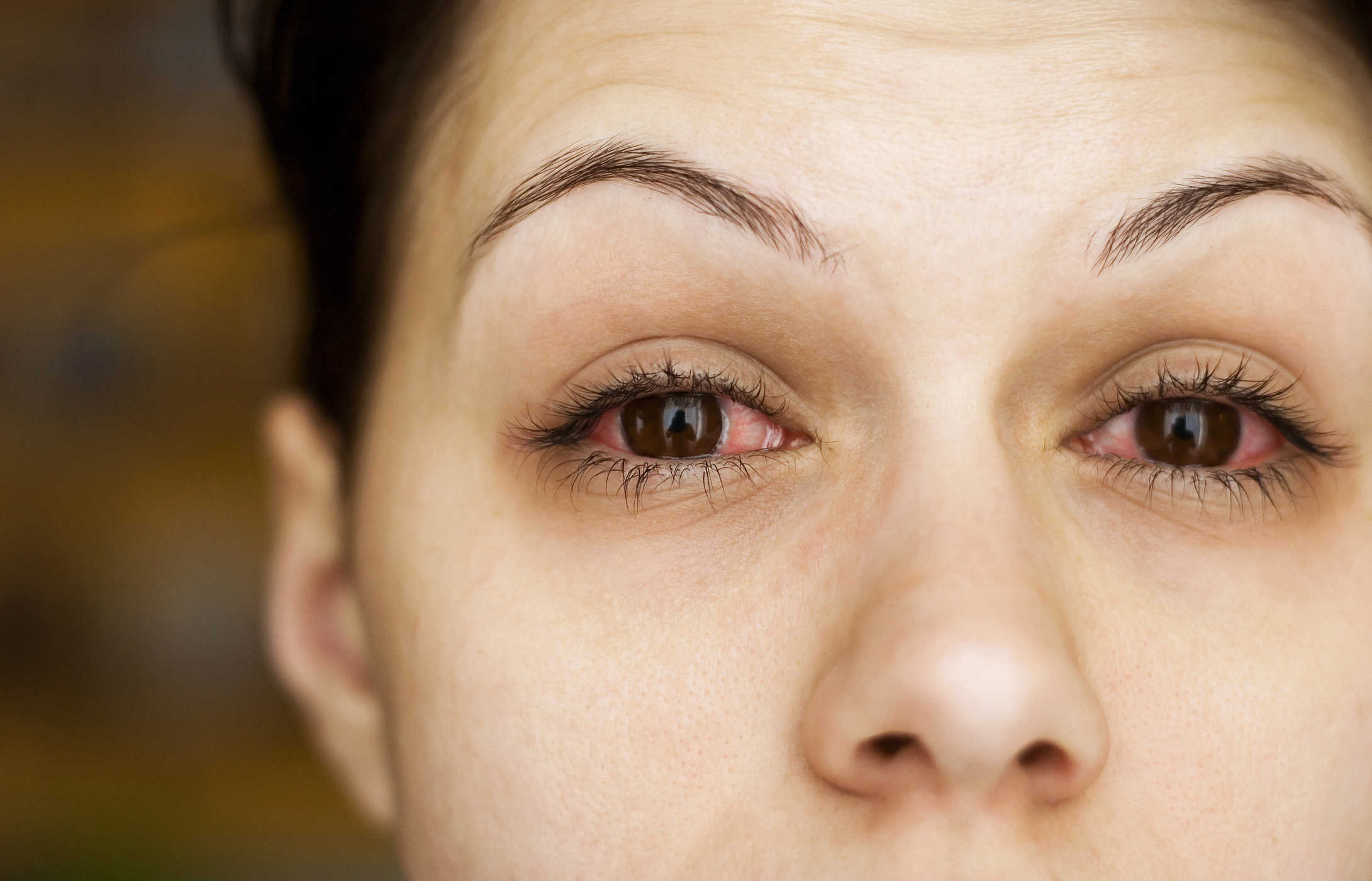التعرف على التهابات العين الناتجة عن استخدام العدسات اللاصقة