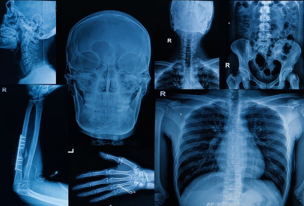 骨疾患の4つのまれなタイプを認識する