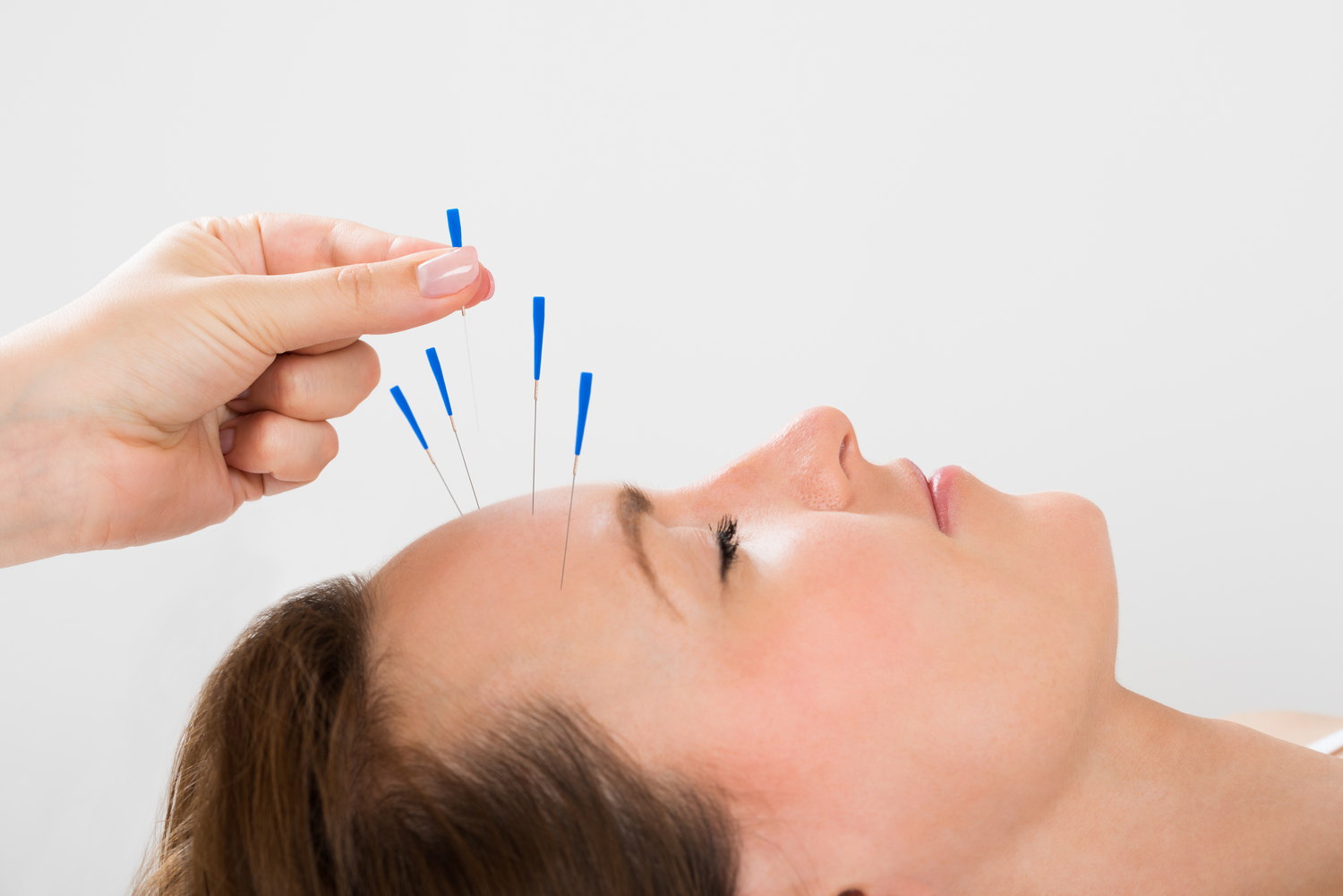 鍼治療は頭痛や片頭痛を和らげることができます