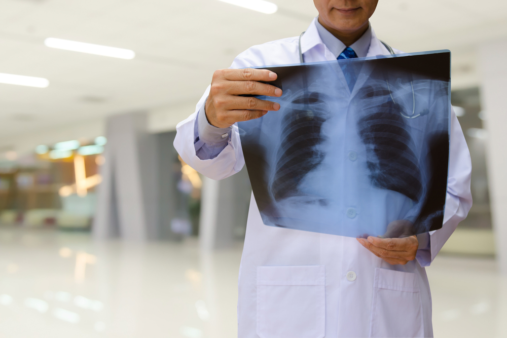 Riconoscere i sintomi, le cause e il trattamento della malattia polmonare restrittiva