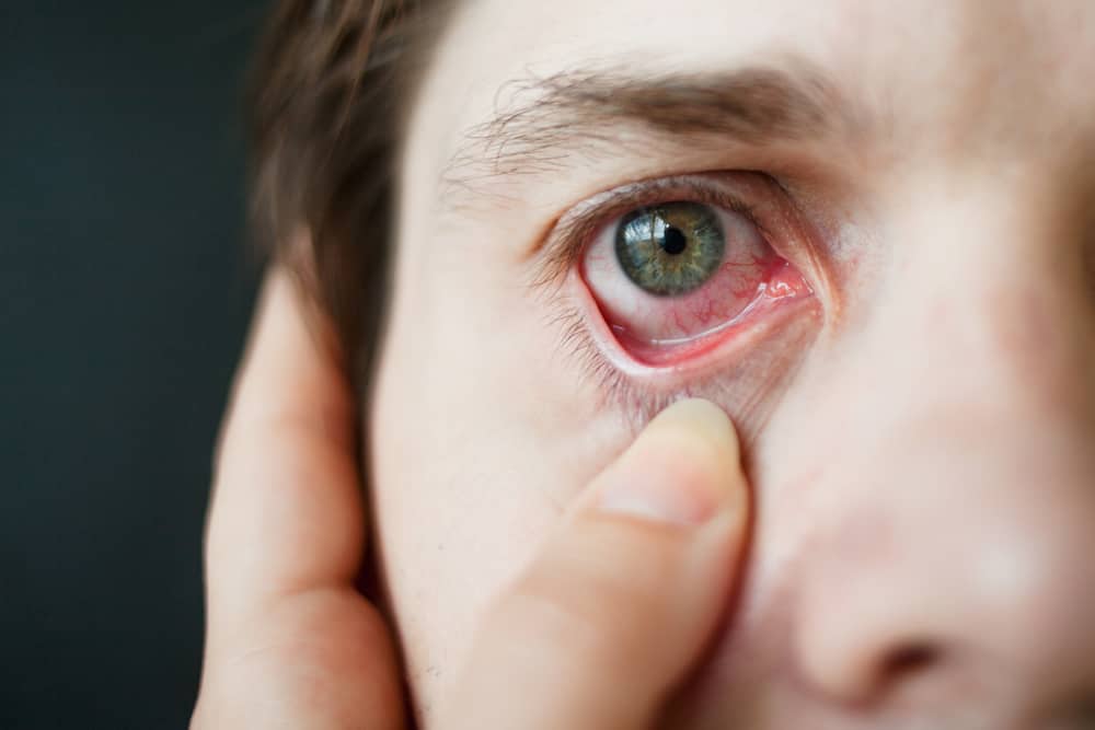 Hati-hati, anda juga boleh mendapat penyakit kelamin di mata! Macam mana boleh jadi?
