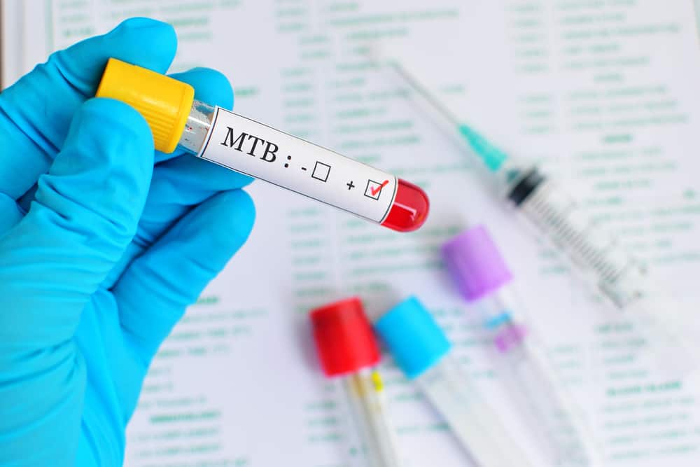 なぜHIV / AIDS患者（PLWHA）は結核の検査をすぐに受けなければならないのですか？