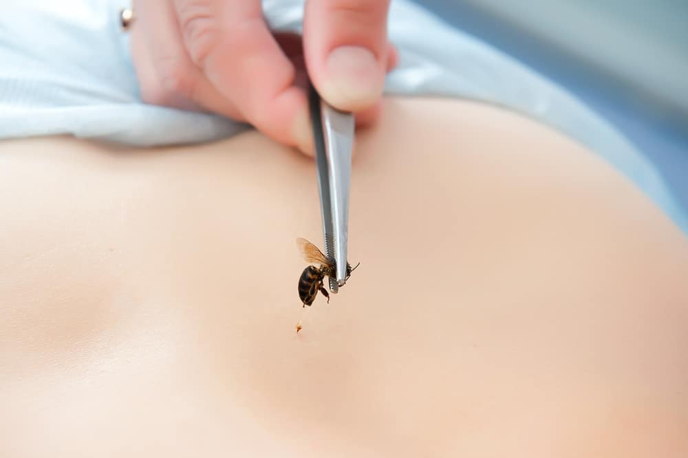 リウマチを治療するための無差別蜂刺され療法は致命的となる可能性があります