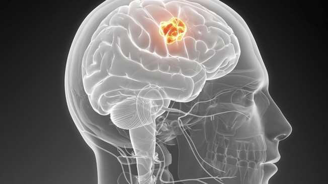 Adakah Semua Tumor Otak Maut?