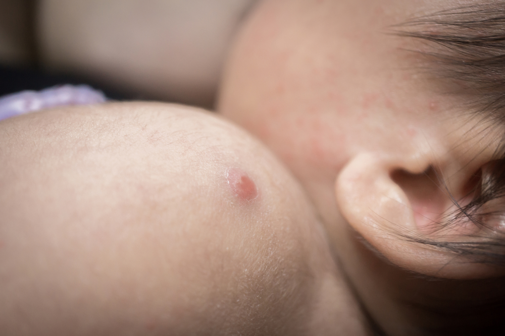 Нормално ли е циреите да се появят след имунизация с BCG?