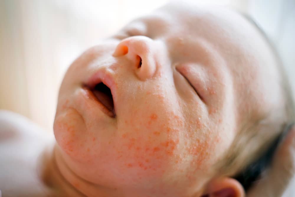 Macchie bianche sul viso del bambino, a causa di acne o milia? Ecco 3 modi per capire la differenza