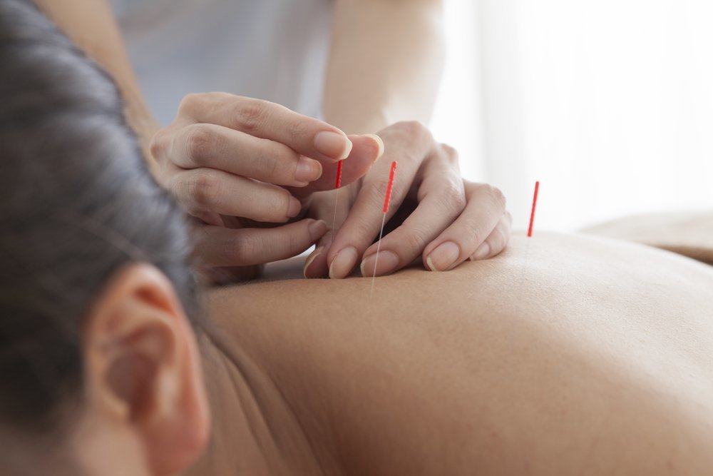 Sudahkah Anda Mencuba Akupunktur untuk Program Hamil?