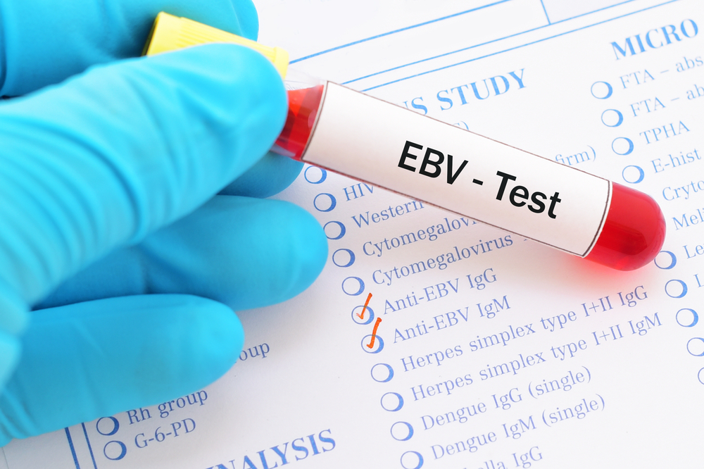 Araştırmalar Epstein-Barr Virüsünün Bu 7 Ciddi Hastalığa Sebep Olabileceğini Gösterdi