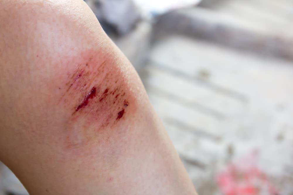 يؤلمك تنظيف الجرح ، هل يعني ذلك أنه سيشفى بسرعة؟
