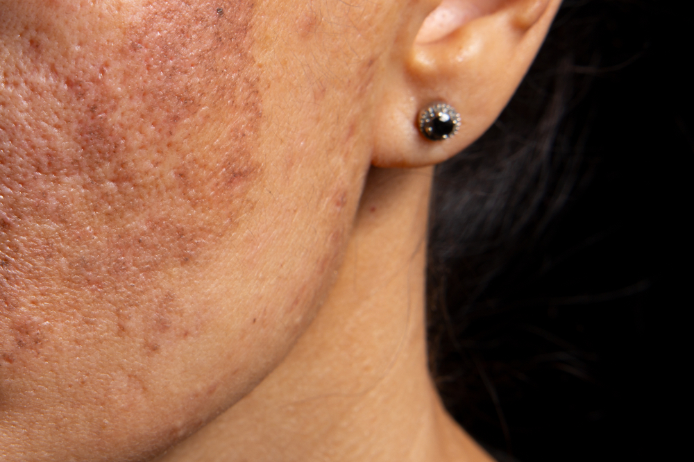 Защо се появява черна кожа при пациенти с бъбречна недостатъчност?